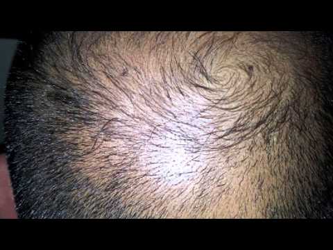 comment appliquer alopexy