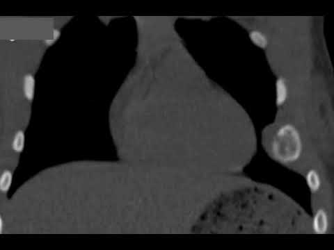 DD OF EXPANSILE RIB LESION