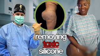 Silicone Injector Gets Silicone REMOVED by Dr. Katzen - Surgical Documentary