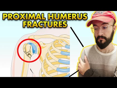 Proximal Humerus Fractures: Neer Classification, Anatomy, Imaging and Treatment