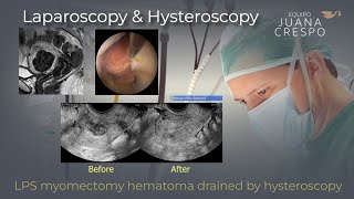 Hematoma post-LPS myomectomy drained by Hysteroscopy