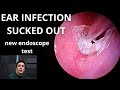 Ear Infection Sucked Out (New Endoscope Test)