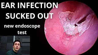 Ear Infection Sucked Out (New Endoscope Test)