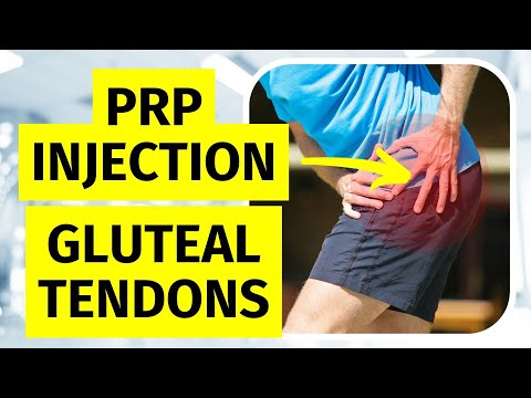 PRP Injection for Trochanteric Bursitis & Gluteal Tendinopathy