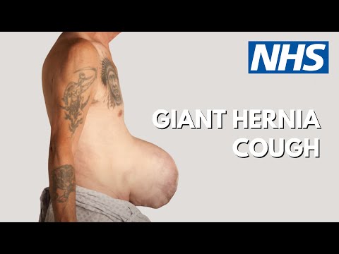 ไส้เลื่อน