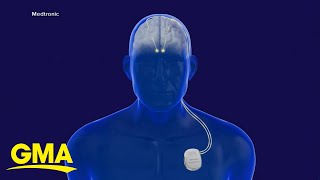 Breakthrough in Parkinson's disease treatment