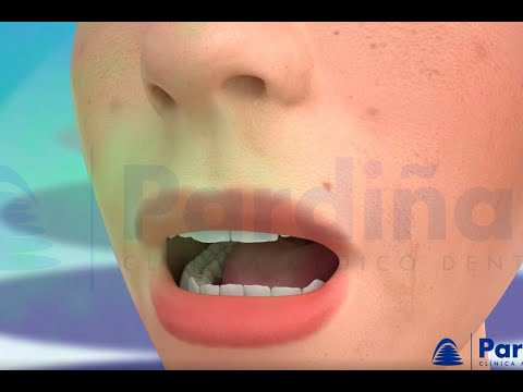 मुंह से दुर्गंध आना (halitosis) ©