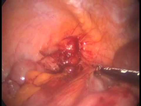 Villous Cecum Adenoma - Laparoscopic Right Colectomy