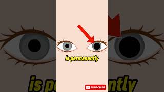 What happened to David Bowies eye?!