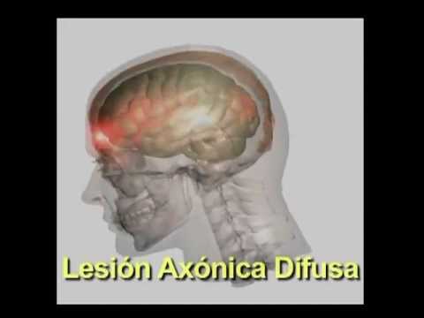 Traumatismo Craneoencefálico TCE