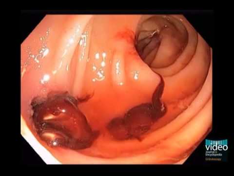Aortoenteric Fistula