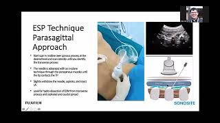 Opioid Sparing US Guided Regional Anaesthesia Technique for Pain Management after Spine Surgery