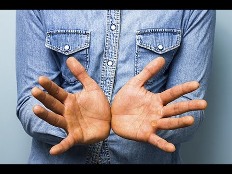 How to treat corns and calluses