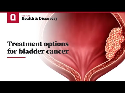 Treatment options for bladder cancer  | Ohio State Medical Center