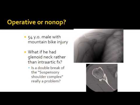 Clavicle fractures - Panel discussion