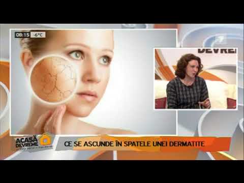 Quello che la psoriasi di malattia influenza Risposte di semigrasso della vitamina f99 alla panna a psoriasi