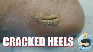 HOW TO GET RID OF CRACKED HEELS - FULL TREATMENT