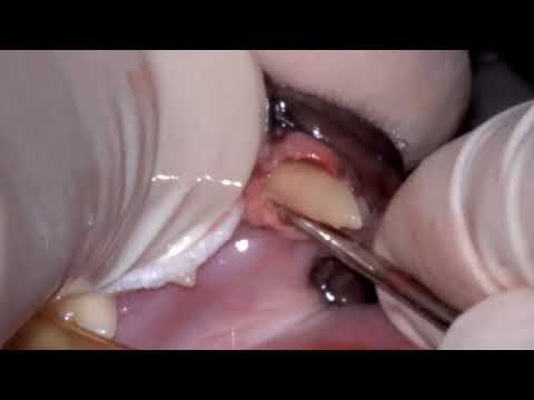 Surgical extraction of the lower left canine tooth in a cat.