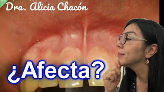 ¿Se deben corregir los frenillos labiales