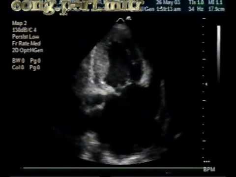 Hypertrophic Cardiomyopathy And Congenital Mitral Valve Perforation