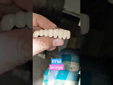 PFM Bridge By Haider #dentist #rpd #dentures