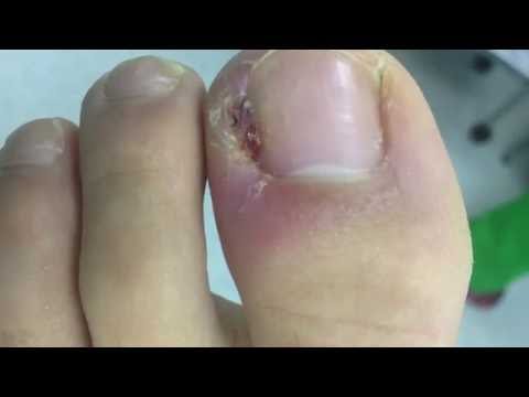 Elena malysheva como he sanado el hongo El ajo para el tratamiento de las uñas