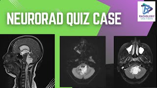 Crack the Case: Neurorad Quiz Challenge! | Dr. Umamaheswara Reddy .V