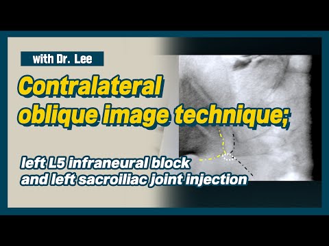 Learn contralateral oblique image C-arm anatomy:  SIJ and infraneural transforaminal injection