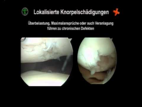 Die Wirkung von Wein auf die Gelenke Wie tun Knieersatz Video