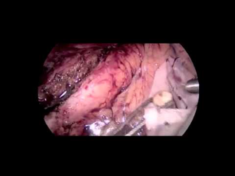 Pancreaticoyeyunostomía lateral laparoscópica