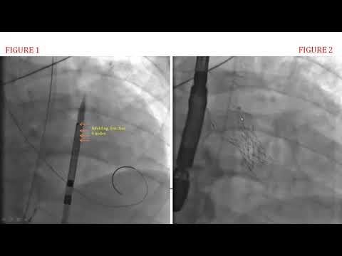 Incomplete Expansion of a Self-Expanding TAVR Device Leading to Hemodynamic collapse