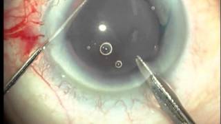 Explante de lente intraocular opacificada - Centro Oftalmológico Doctores Campello