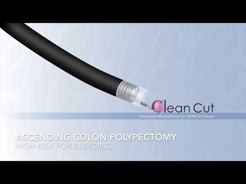 Colonoscopy: Ascending Colon Pedunculated Polyp Resection