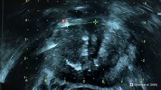 Core Videos (2025): Focal Therapy for Prostate Cancer: NanoKnife Irreversible Electroporation (IRE)