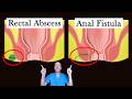 Rectal Abscess and Fistula Explained: A complete understanding