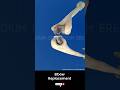 Total Elbow Replacement ↪ 3D Medical Animation #Shorts #ElbowReplacement #Elbow #Surgery