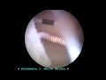 Copper T Displaced In The Uterus