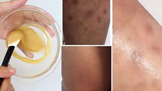 How to get Rid of Dark Spots, Scars, Mosquito Bites, Hyperpigmentation on Legs Fast