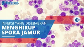 Histoplasmosis, Infeksi yang Disebabkan karena Menghirup Jamur Histoplasma Capsulatum