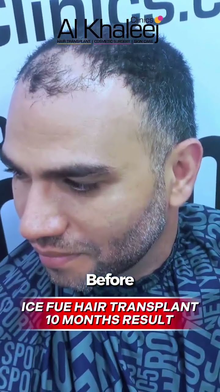 Before you book watch this - real hair transplant results from Karachi
