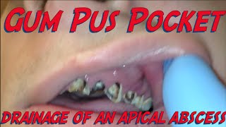 a pus pocket in the gum