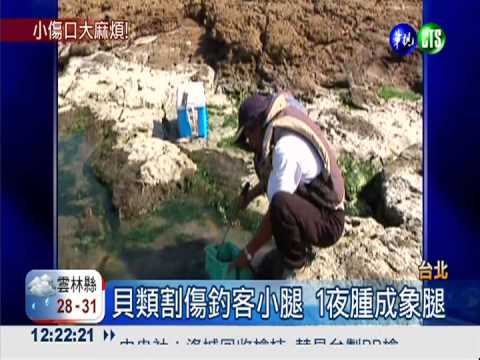 貝類割傷小腿 釣客染菌險沒命!