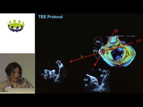 Bushra Rana - The gold standard; TEE assessment before, during, and after LAA occlusion