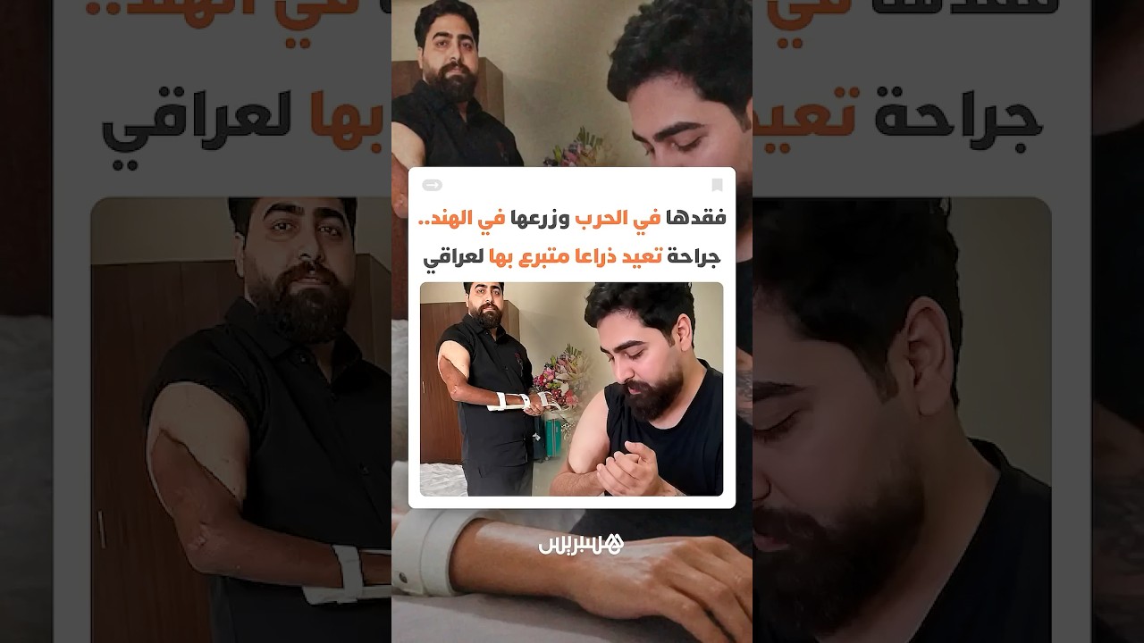 فقدها في الحرب وزرعها في الهند.. جراحة تعيد ذراعا متبرع بها لعراقي thumbnail