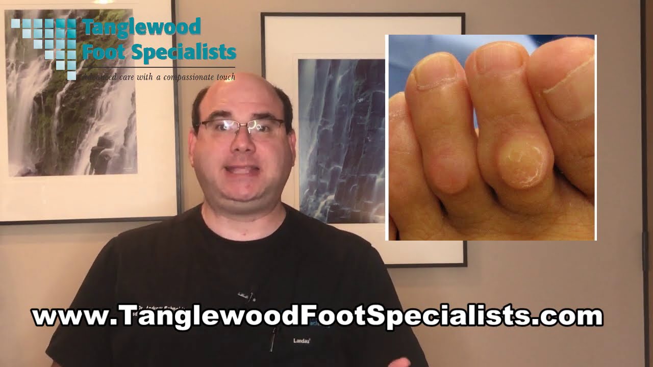 Why I Don't Like Corn and Callus Removers