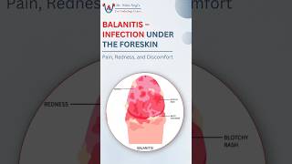 Download lagu What Is Balanitis? Painful Foreskin Infection Explained | Best Urologist || Dr Nitin Negi #shorts mp3
