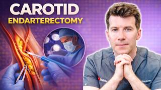 Doctor explains Carotid Endarterectomy | Procedure, benefits, risks and recovery