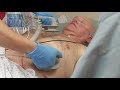 Manual Defibrillation With The HeartStart Intrepid Monitor Defibrillator