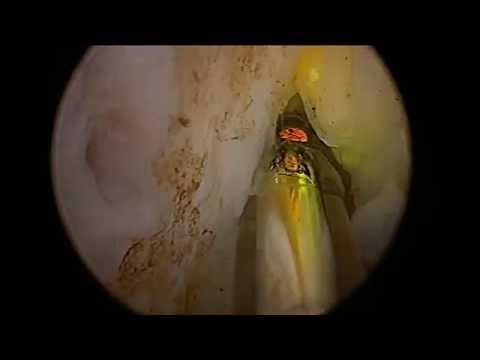 Gesundheit massagers Prostata Microclyster mit ASD mit Prostatitis