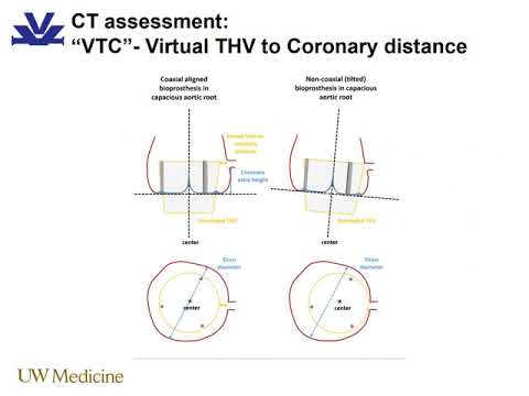 Valve in Valve TAVR; Predicting When the Coronaries Are At Risk